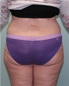 Liposuction Before Photo by Jennifer Greer, MD; Mentor, OH - Case 41018
