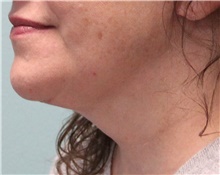 Neck Lift After Photo by Jennifer Greer, MD; Mentor, OH - Case 41019