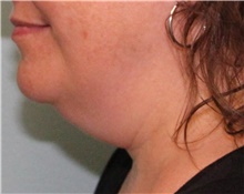 Neck Lift Before Photo by Jennifer Greer, MD; Mentor, OH - Case 41019