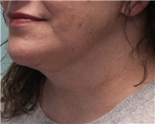 Neck Lift After Photo by Jennifer Greer, MD; Mentor, OH - Case 41019