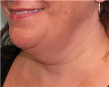 Neck Lift Before Photo by Jennifer Greer, MD; Mentor, OH - Case 41019
