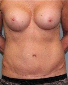 Tummy Tuck After Photo by Jennifer Greer, MD; Mentor, OH - Case 41020