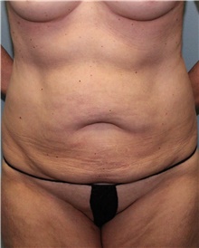 Tummy Tuck Before Photo by Jennifer Greer, MD; Mentor, OH - Case 41020