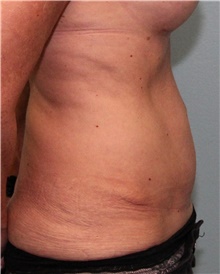 Tummy Tuck After Photo by Jennifer Greer, MD; Mentor, OH - Case 41020