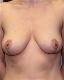 Breast Lift After Photo by Jennifer Greer, MD; Mentor, OH - Case 41021