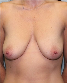 Breast Lift Before Photo by Jennifer Greer, MD; Mentor, OH - Case 41021