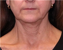 Facelift Before Photo by Jennifer Greer, MD; Mentor, OH - Case 41057