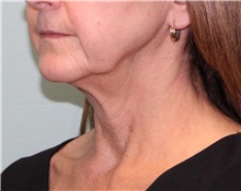 Facelift Before Photo by Jennifer Greer, MD; Mentor, OH - Case 41057