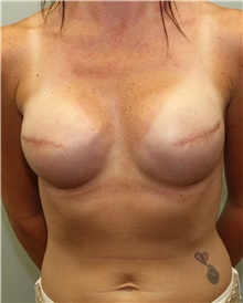 Breast Reconstruction After Photo by Jennifer Greer, MD; Mentor, OH - Case 41058