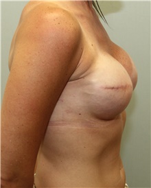 Breast Reconstruction After Photo by Jennifer Greer, MD; Mentor, OH - Case 41058