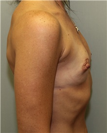Breast Reconstruction Before Photo by Jennifer Greer, MD; Mentor, OH - Case 41058