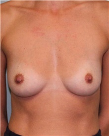 Breast Augmentation Before Photo by Jennifer Greer, MD; Mentor, OH - Case 41059