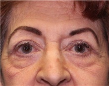 Eyelid Surgery After Photo by Jennifer Greer, MD; Mentor, OH - Case 41078