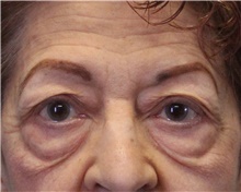 Eyelid Surgery Before Photo by Jennifer Greer, MD; Mentor, OH - Case 41078