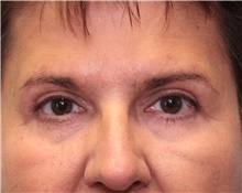 Eyelid Surgery After Photo by Jennifer Greer, MD; Mentor, OH - Case 41079