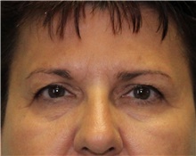 Eyelid Surgery Before Photo by Jennifer Greer, MD; Mentor, OH - Case 41079