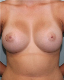 Breast Augmentation After Photo by Jennifer Greer, MD; Mentor, OH - Case 41089
