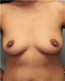 Breast Augmentation Before Photo by Jennifer Greer, MD; Mentor, OH - Case 41090