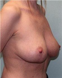 Breast Reduction After Photo by Jennifer Greer, MD; Mentor, OH - Case 41091