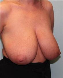 Breast Reduction Before Photo by Jennifer Greer, MD; Mentor, OH - Case 41091