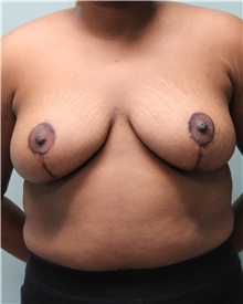 Breast Reduction After Photo by Jennifer Greer, MD; Mentor, OH - Case 41092