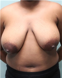 Breast Reduction Before Photo by Jennifer Greer, MD; Mentor, OH - Case 41092