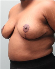 Breast Reduction After Photo by Jennifer Greer, MD; Mentor, OH - Case 41092