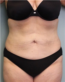 Liposuction After Photo by Jennifer Greer, MD; Mentor, OH - Case 41101