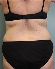 Liposuction After Photo by Jennifer Greer, MD; Mentor, OH - Case 41101