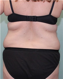 Liposuction Before Photo by Jennifer Greer, MD; Mentor, OH - Case 41101