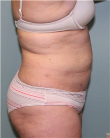 Liposuction After Photo by Jennifer Greer, MD; Mentor, OH - Case 41102