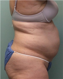 Liposuction Before Photo by Jennifer Greer, MD; Mentor, OH - Case 41102