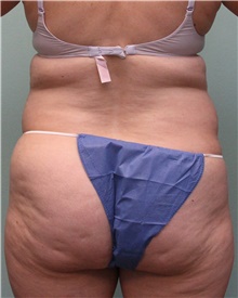 Liposuction Before Photo by Jennifer Greer, MD; Mentor, OH - Case 41102