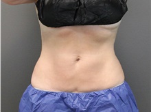 Nonsurgical Fat Reduction After Photo by Jennifer Greer, MD; Mentor, OH - Case 41124