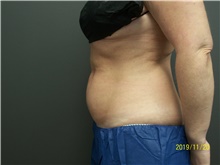 Nonsurgical Fat Reduction Before Photo by Jennifer Greer, MD; Mentor, OH - Case 41124