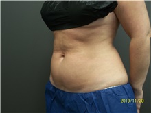 Nonsurgical Fat Reduction Before Photo by Jennifer Greer, MD; Mentor, OH - Case 41124