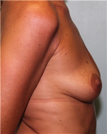 Breast Lift After Photo by Jennifer Greer, MD; Mentor, OH - Case 41125