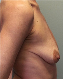 Breast Lift Before Photo by Jennifer Greer, MD; Mentor, OH - Case 41125