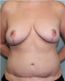Tummy Tuck After Photo by Jennifer Greer, MD; Mentor, OH - Case 41130