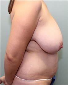 Tummy Tuck Before Photo by Jennifer Greer, MD; Mentor, OH - Case 41130