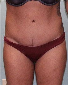 Tummy Tuck After Photo by Jennifer Greer, MD; Mentor, OH - Case 41131