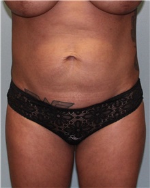 Tummy Tuck Before Photo by Jennifer Greer, MD; Mentor, OH - Case 41131