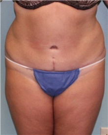 Tummy Tuck After Photo by Jennifer Greer, MD; Mentor, OH - Case 41132