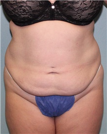 Tummy Tuck Before Photo by Jennifer Greer, MD; Mentor, OH - Case 41132