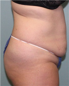 Tummy Tuck Before Photo by Jennifer Greer, MD; Mentor, OH - Case 41132