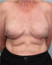Breast Reconstruction After Photo by Jennifer Greer, MD; Mentor, OH - Case 41133