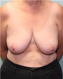 Breast Reconstruction Before Photo by Jennifer Greer, MD; Mentor, OH - Case 41133