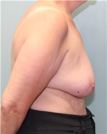 Breast Reconstruction Before Photo by Jennifer Greer, MD; Mentor, OH - Case 41133