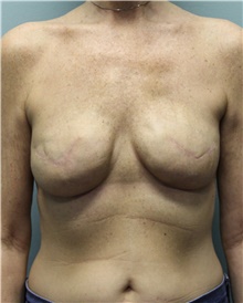 Breast Reconstruction After Photo by Jennifer Greer, MD; Mentor, OH - Case 41134