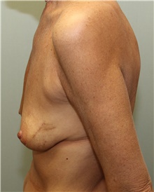 Breast Reconstruction Before Photo by Jennifer Greer, MD; Mentor, OH - Case 41134